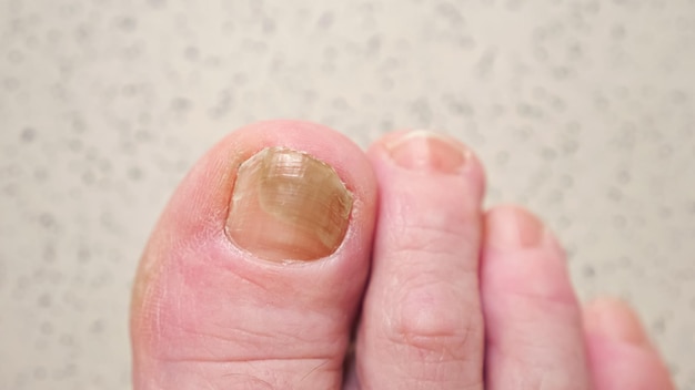 Uñas de los pies con infección por hongos y hematomas en la macro del dedo gordo del pie