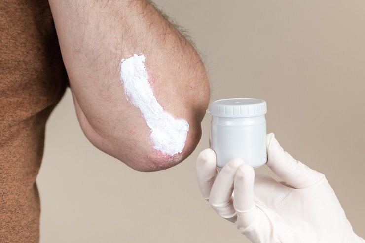 Foto ungüento para psoriasis. un dermatólogo con guantes aplica una pomada terapéutica a la piel afectada de un paciente con psoriasis. tratamiento de dermatosis crónica, eccema, dermatitis.