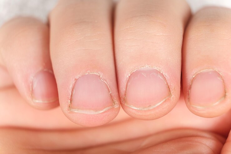 Foto unhas masculinas despenteadas com uma cutícula crescida