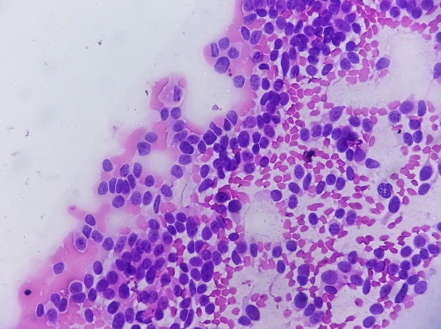 USG-geführte FNA-Zytologie von Leber-SOL mit Non-Hodgkin-Lymphom Metastasierendes Karzinom