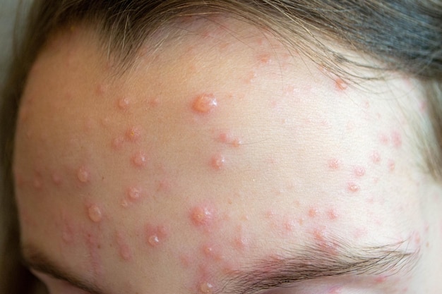 Foto vacinação natural doença contagiosa criança doente com varíola