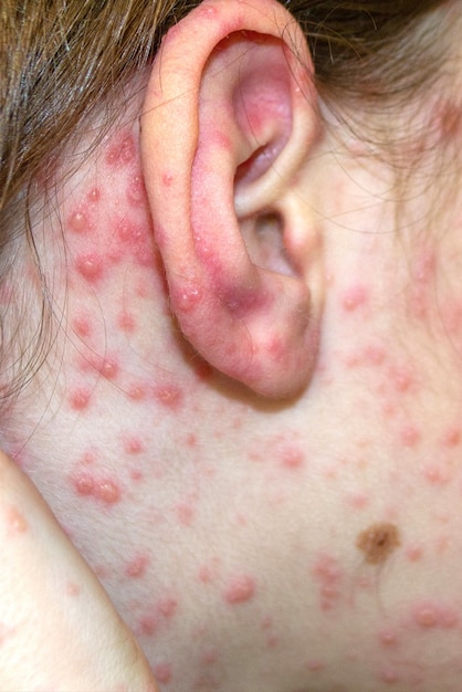 Foto vacinação natural doença contagiosa criança doente com varíola