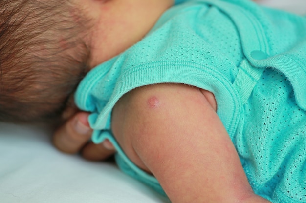 Foto vacuna de bacille calmette guerin en el hombro del bebé