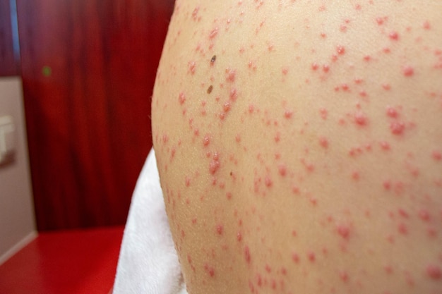 Vacunación natural enfermedad contagiosa niño enfermo con varicela o varicela