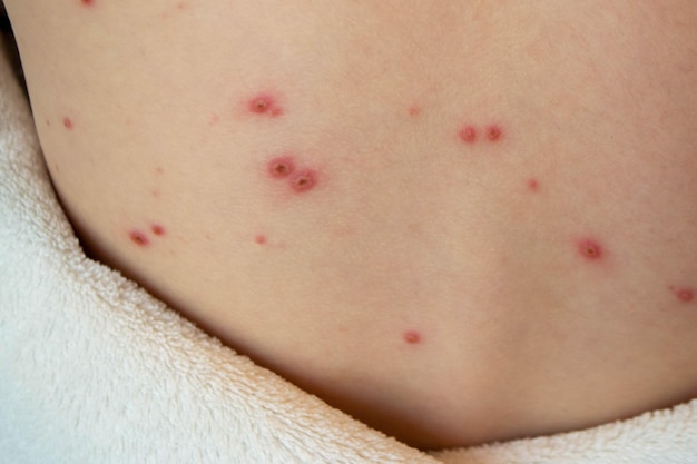 Vacunación natural Enfermedad contagiosa