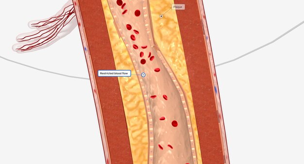 Foto vaso sanguíneo estrechado en la extremidad inferior
