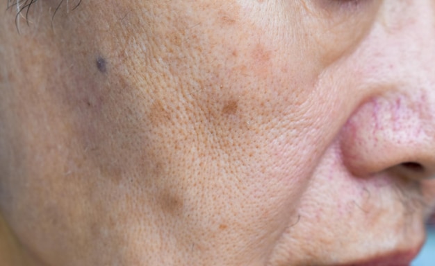 Vergrößerte Poren im Gesicht eines asiatischen älteren Mannes mit Hautfalten
