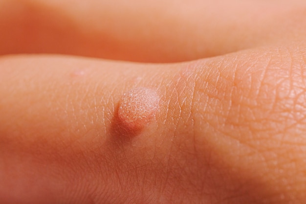 Verruga común Verruca vulgar es una verruga plana que se encuentra comúnmente en la mano de niños y adultos. Son causadas por un tipo de VPH del virus del papiloma humano.