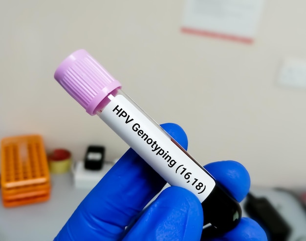 Vírus do papiloma humano ou teste de PCR de genotipagem de HPV