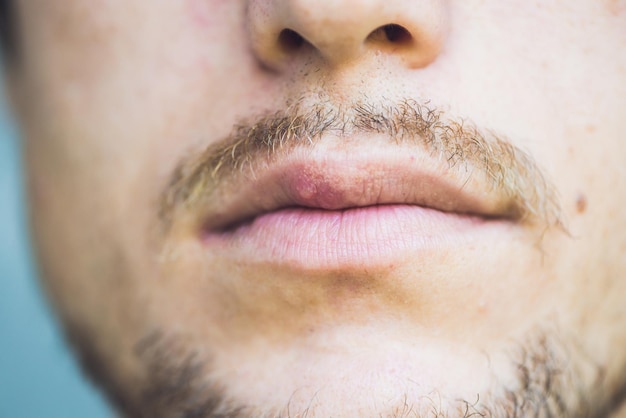 Vírus herpes infectado no lábio masculino, close up