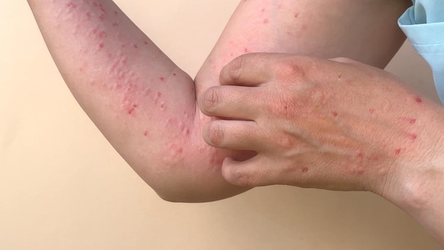 Virus de la viruela del mono, un nuevo problema mundial de la humanidad moderna Primer plano de las manos de una persona enferma con granos y ampollas