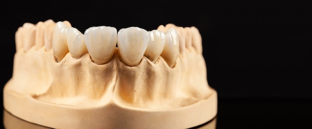 Visão aproximada do layout dentário das facetas superiores da prótese dentária