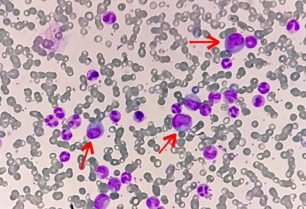 Foto visão microscópica de 100x da leucemia mielocítica crônica ou lmc