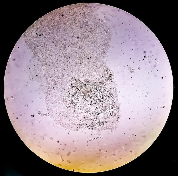 Visão microscópica de raspagem de pele para teste de fungos mostrando dermatófitos
