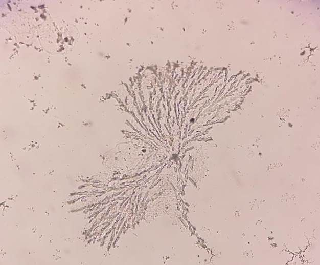 Foto visão microscópica de raspagem de unhas para teste de fungos mostrando dermatófitos