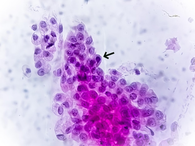 Visão microscópica de Trichomonas vaginalis em exame de Papanicolaou com poucas células inflamatórias agudas. DST, DST