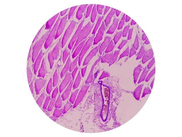 Visão microscópica do estudo histológico do tecido mostrando Rabdomioma