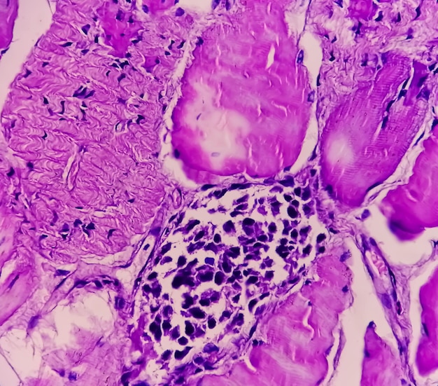 Visão microscópica do estudo histológico do tecido mostrando Rabdomioma