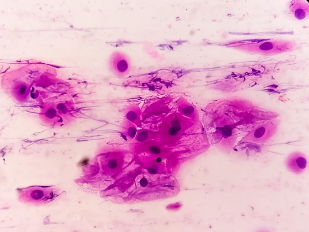 Visão microscópica mostra lesão intraepitelial escamosa de alto grau ou esfregaço de papanicolau