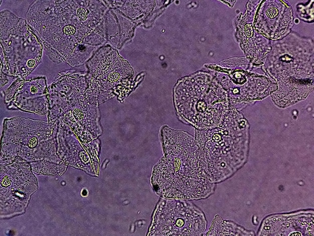 Visão próxima fotomicrográfica da análise de urina anormal com espaço de cópia. Célula epitelial, Célula de pus