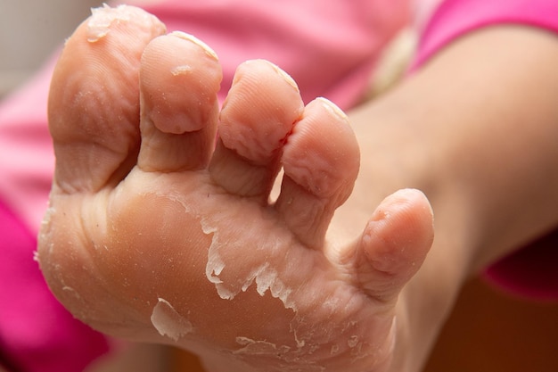 Vista detalhada do pé feminino com a pele descascando após o banho Derm danificado descascando Fundo rosa Conceito de cuidados com a pele e os pés de saúdexDxA