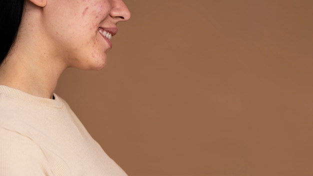 Vista lateral jovem mulher com acne