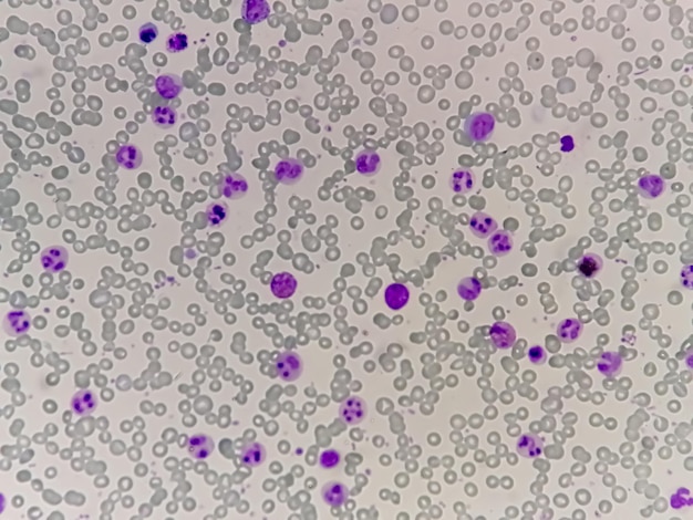 Foto vista microscópica de 100x de leucemia mielocítica crónica o lmc