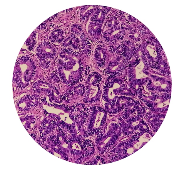 Vista microscópica de Adenocarcinoma con un foco de 40x