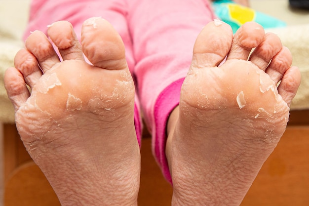 Vista de los pies de la mujer con la piel pelándose después del baño Derm dañado pelándose Concepto de cuidado de la piel y los pies