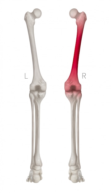 Foto vista posterior del hueso de la pierna humana con reflejos rojos en el dolor del hueso del fémur, aislado sobre fondo blanco