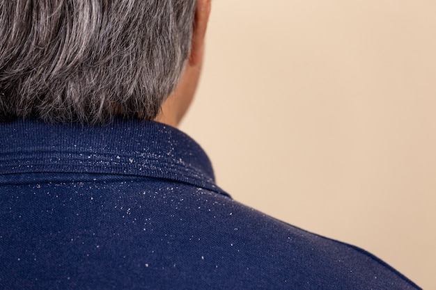 Vista de primer plano de un hombre que tiene mucha caspa del cabello en la camisa y los hombros