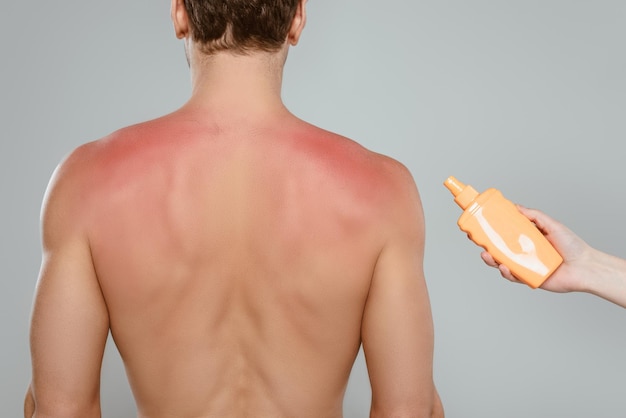 Vista recortada de la mujer que sostiene la botella de protector solar cerca del hombre con quemaduras solares aisladas en gris