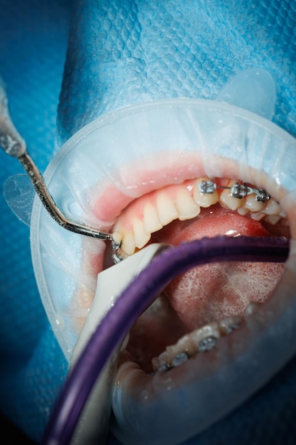 Vista superior del proceso de cepillado de los dientes de los pacientes Limpieza de dientes con chorro de agua y eyector de saliva Retractor de mejillas en los labios El concepto de higiene oral profesional Frenos en los dientes