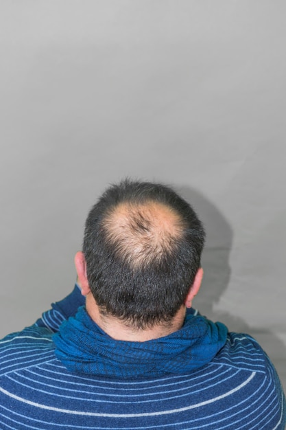 Vista trasera de un hombre con la línea del cabello retrocediendo contra un fondo gris