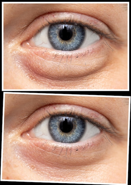 Vistas de primer plano del collage de ojos de mujer Comparación de antes y después de la intervención de cuidado de la belleza Concepto de salud y cuidado de la pielxDxA