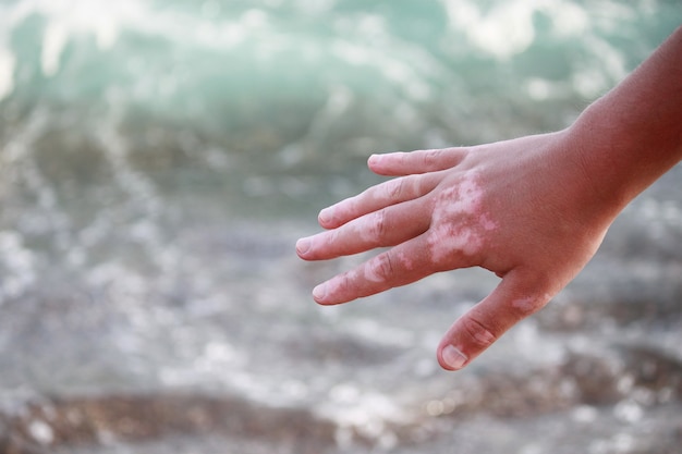 Vitiligo en la mano en el fondo del mar.