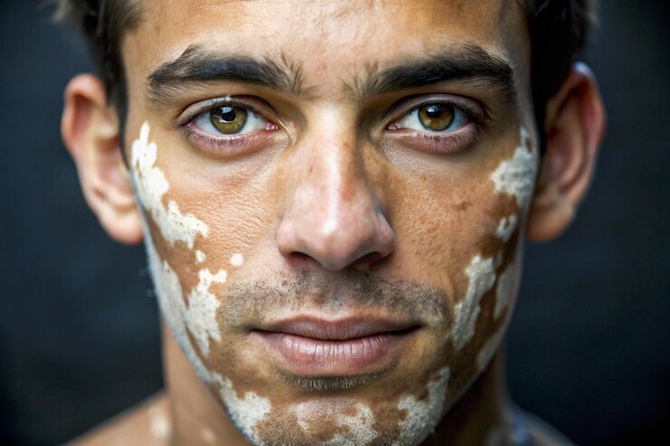 Foto vitiligo