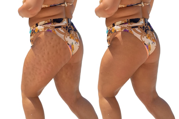 Vor und nach der Behandlung von Cellulite