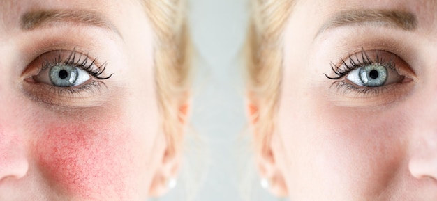 Vor und nach der Laserbehandlung bei Rosacea