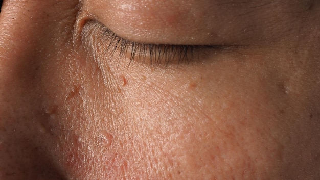 Warze im Gesicht. Makroaufnahme der Warze in der Nähe des Auges. Papillom auf der Haut um die Augen, Nase und Hals. Nahaufnahme von Muttermal Papille oder Maulwurf auf der Haut. klein schwer. gutartiges Wachstum auf der Haut. durch Viren verursacht. Hautpflege.
