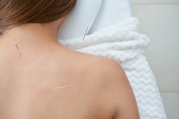 Weiblicher Rücken mit Nadeln auf der Akupunkturbehandlungstherapie in der alternativen Medizin des Spa-Salons