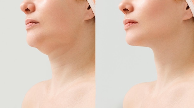 Weibliches Doppelkinn vor und nach der Korrektur Korrektur der Kinnform Fettabsaugung des Halses Das Ergebnis des Eingriffs in der Klinik für ästhetische Medizin