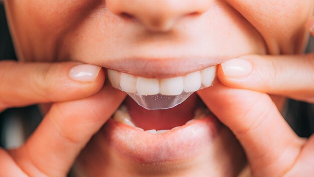 Whitestrips o Tiras Blanqueadoras de Dientes