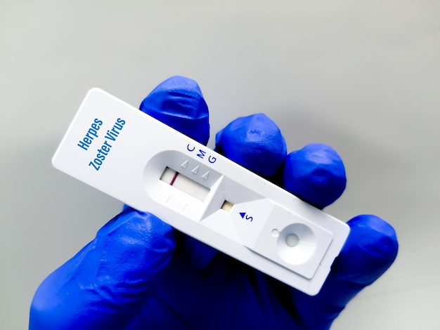 Wissenschaftler, der eine Testkassette für den Herpesvirus-Schnelltest von IgG und IgM hält
