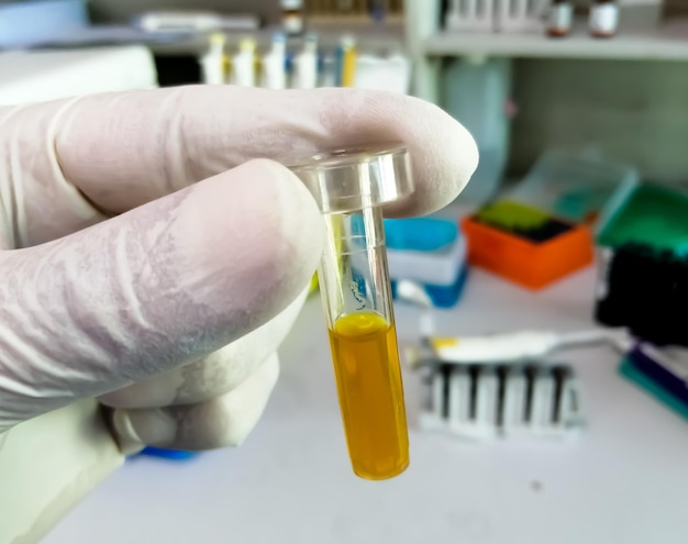 Wissenschaftler halten ikterische oder Hyperbilirubinämie-Blutprobe für den Test im Labor