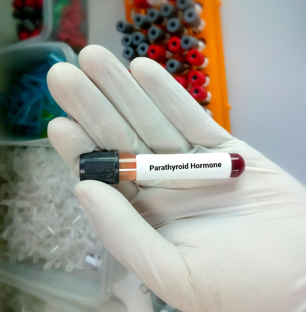 Wissenschaftler oder Biochemiker halten eine Probe für den Parathormon- oder PTH-Test