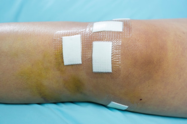 El yeso cerca de la herida en la rodilla causó cirugía del ligamento cruzado posterior (PCL), concepto médico y de atención médica