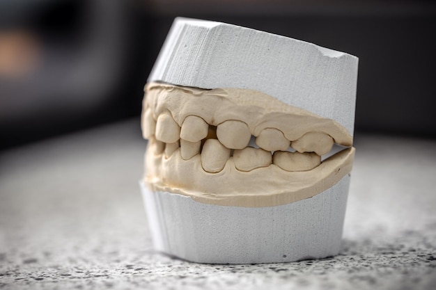 Foto yeso modelo de yeso para fundición dental