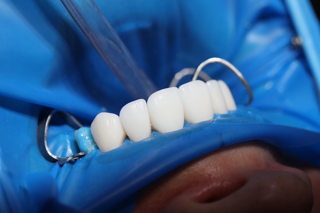 Zähne des Patienten mit Furnieren, die vom Zahnarzt in Nahaufnahme behandelt werden