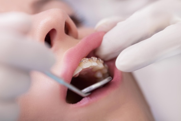 Zahnarzt überprüft Klammer an den Zahnspangen der Patientin. Nahansicht. Echte Menschen.